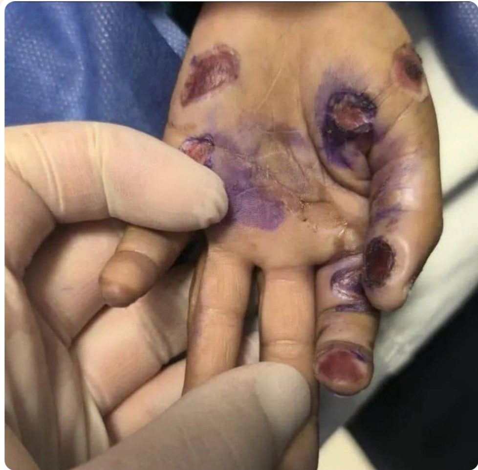 🔺کودک ۴ ساله در هرمزگان قربانی کودکآزاری شد